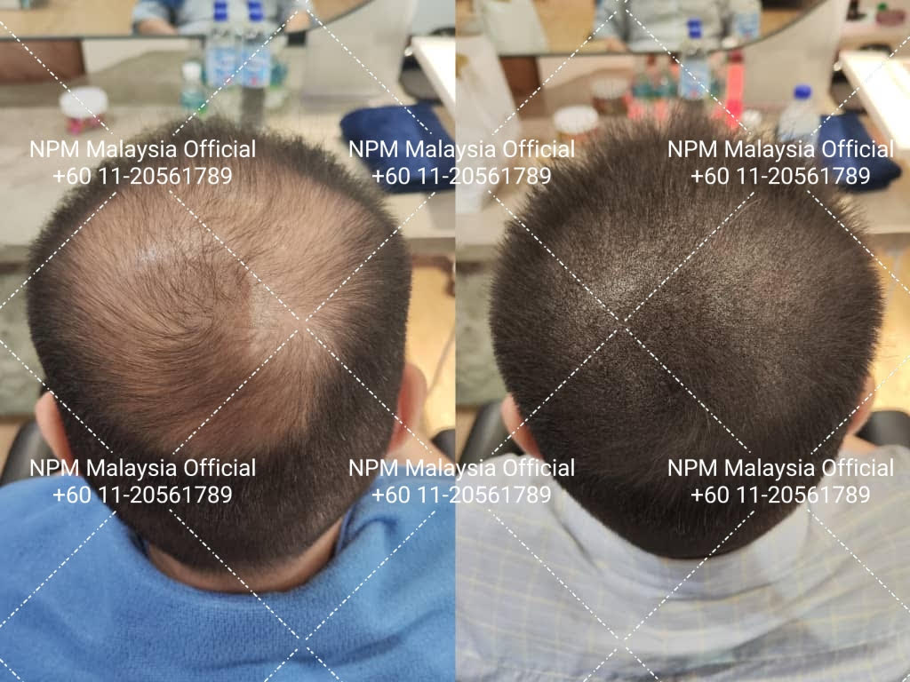 Advanced thinning treatment