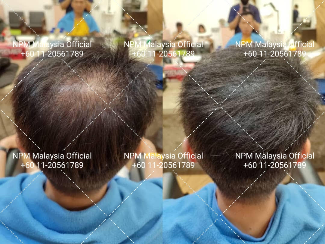 Overall hair density improvement
