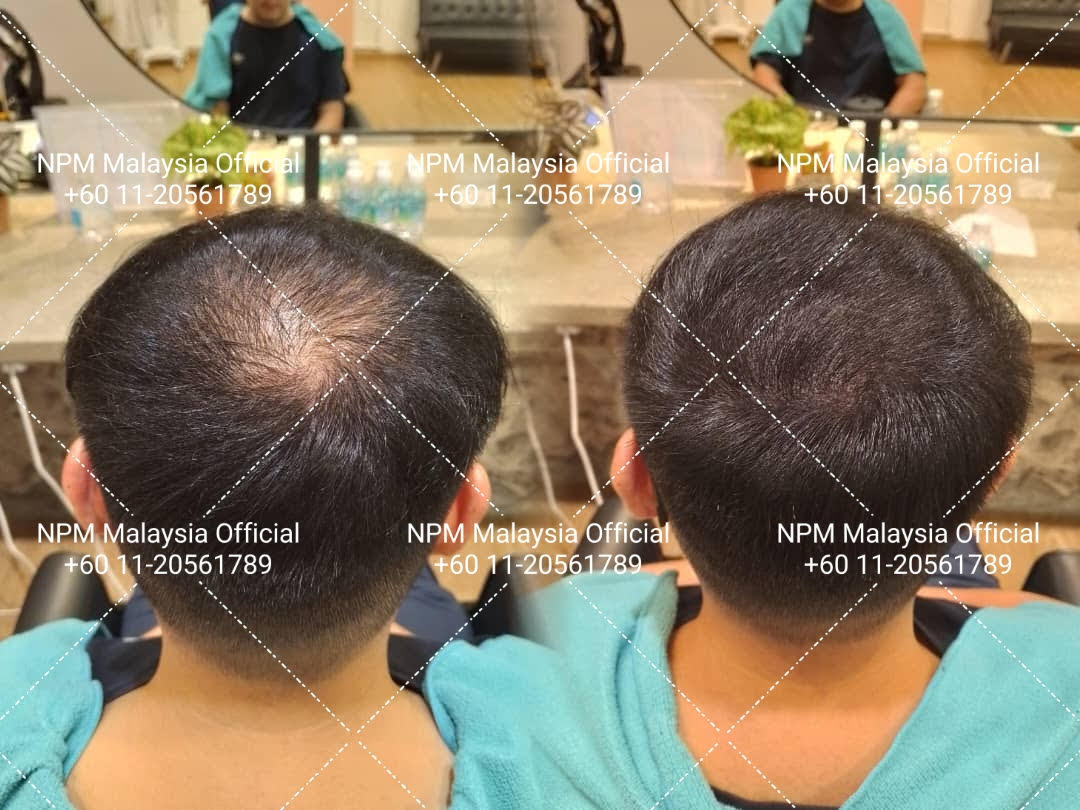 Thinning hair treatment - Increased density