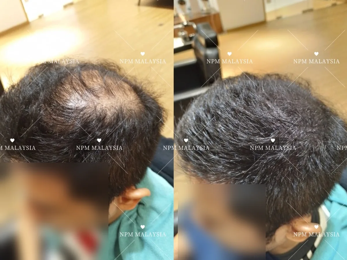 NPM customer before and after Simulation & Stimulation