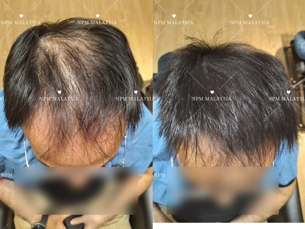 NPM customer before and after Simulation & Stimulation