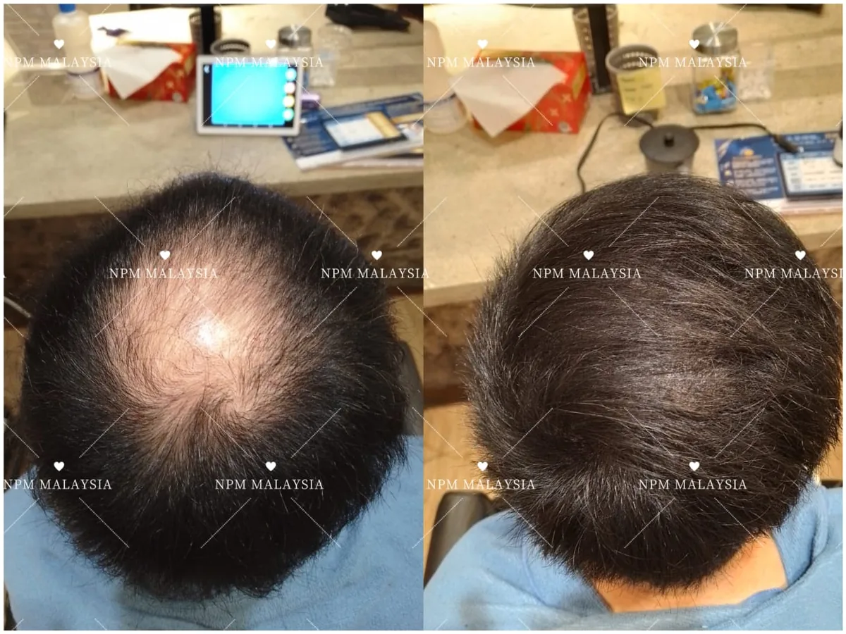 NPM customer before and after Simulation & Stimulation