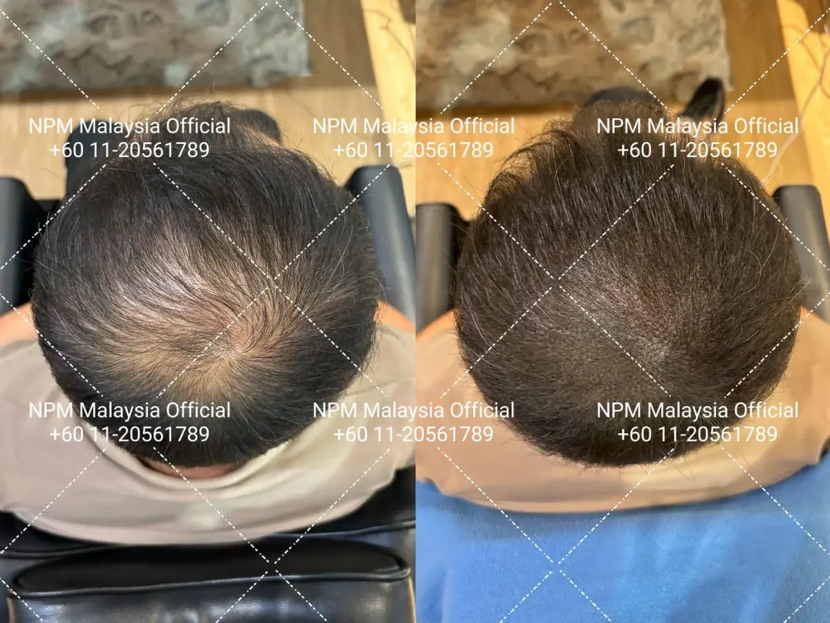 NPM顾客拟发生发前后对比