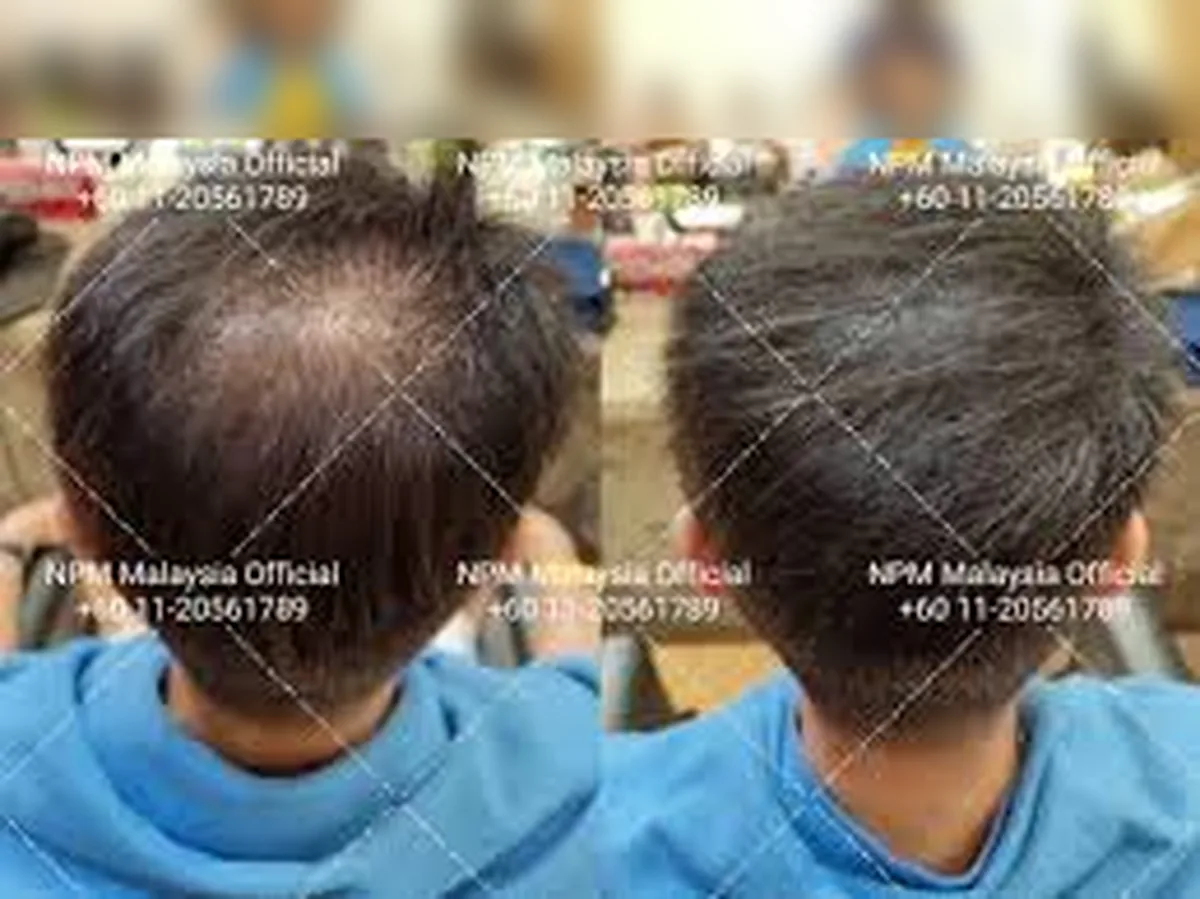 NPM customer before and after Simulation & Stimulation