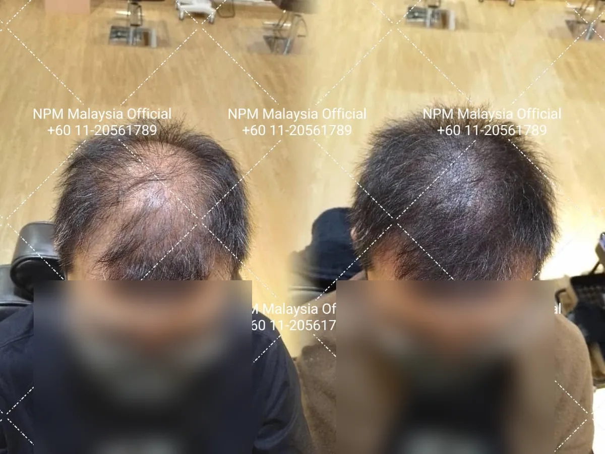 NPM customer before and after Simulation & Stimulation